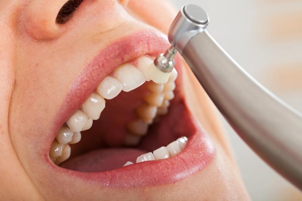 Close-up of a dental tool polishing a person's tooth.