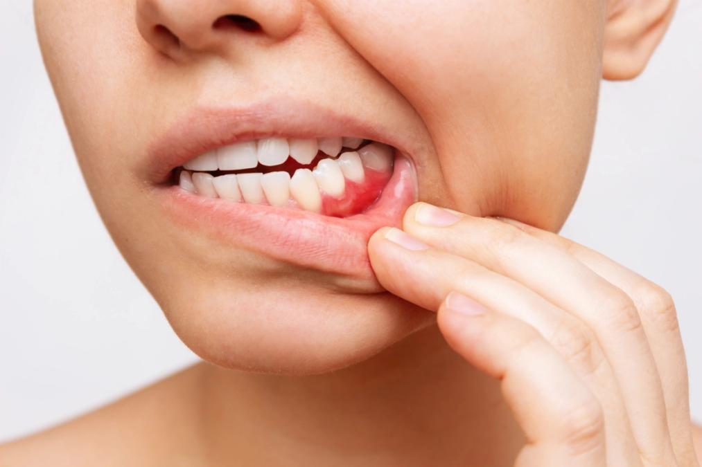 A person pulls down their lower lip to show inflamed, red gums.