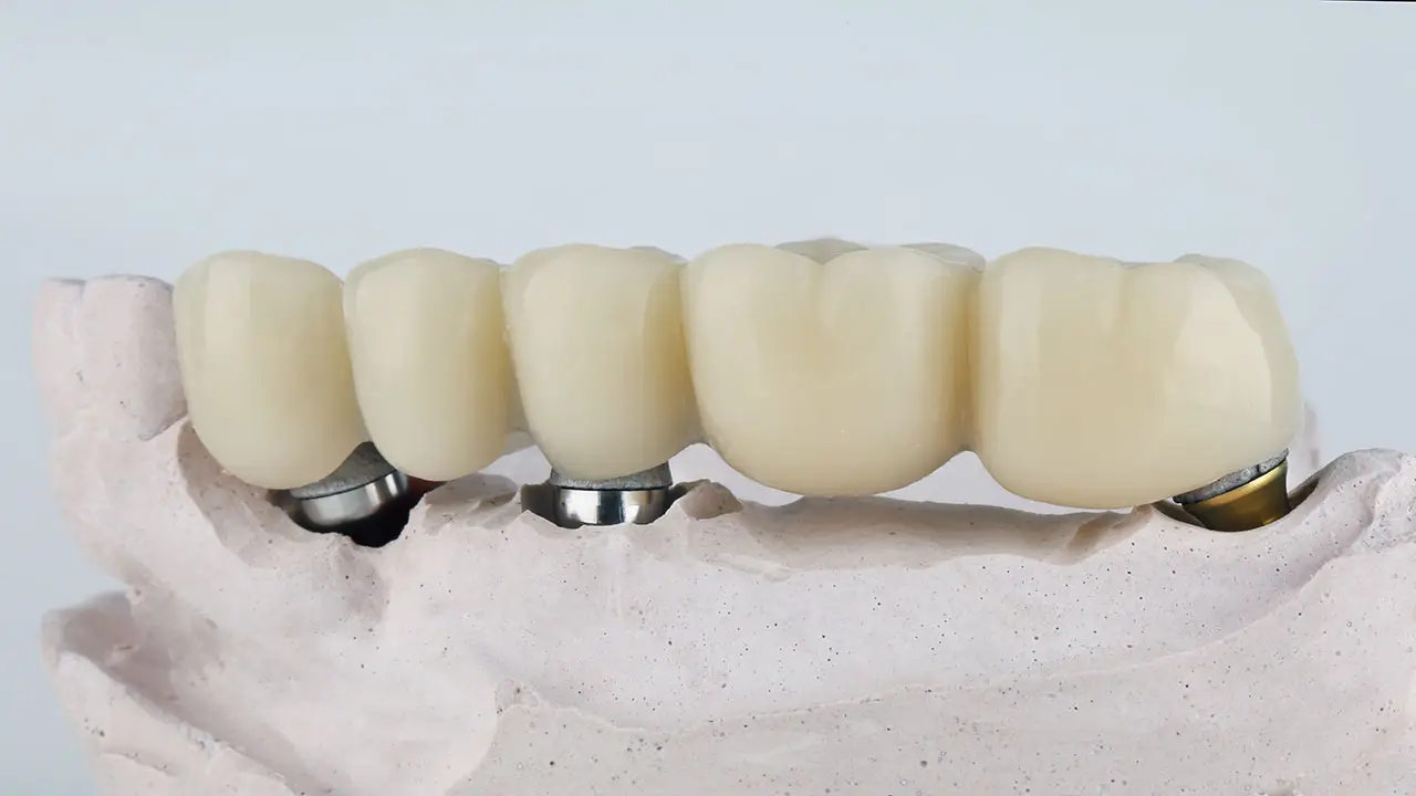 Implant-Supported Bridges In Largo: A Stable Option For Multiple Missing Teeth