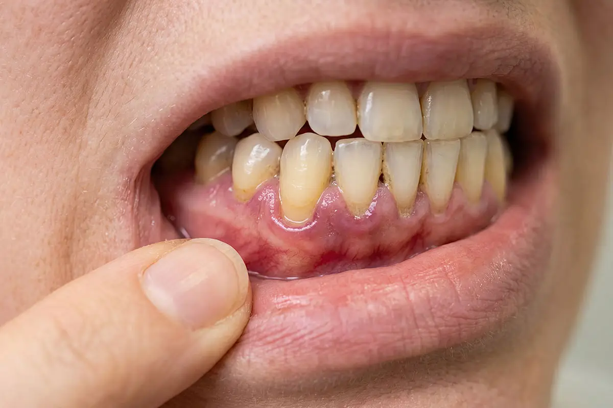 Oral Cancer Screening In Coral Springs: What It Is, Why It Matters, And What To Expect